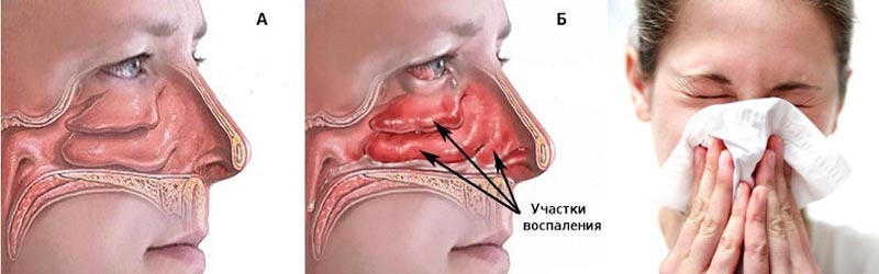 ЛОР Кабинет Днепр. Лечение аллергического ринита.