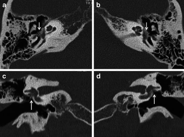 диагностика отосклероза
