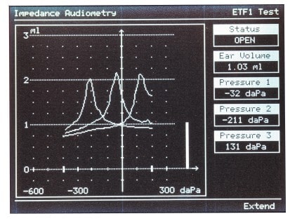 график нормальной функции импедансометрии