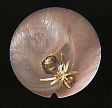 ЛОР КАбинет Днепр. Инородные тела в наружном слуховом проходе.