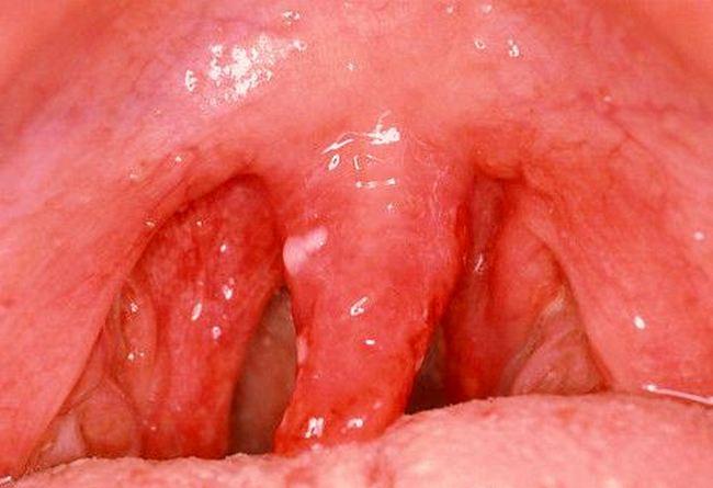 катаральная ангина