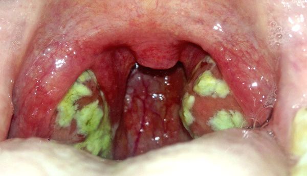 лакунарная ангина