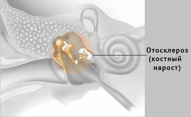 Отосклероз