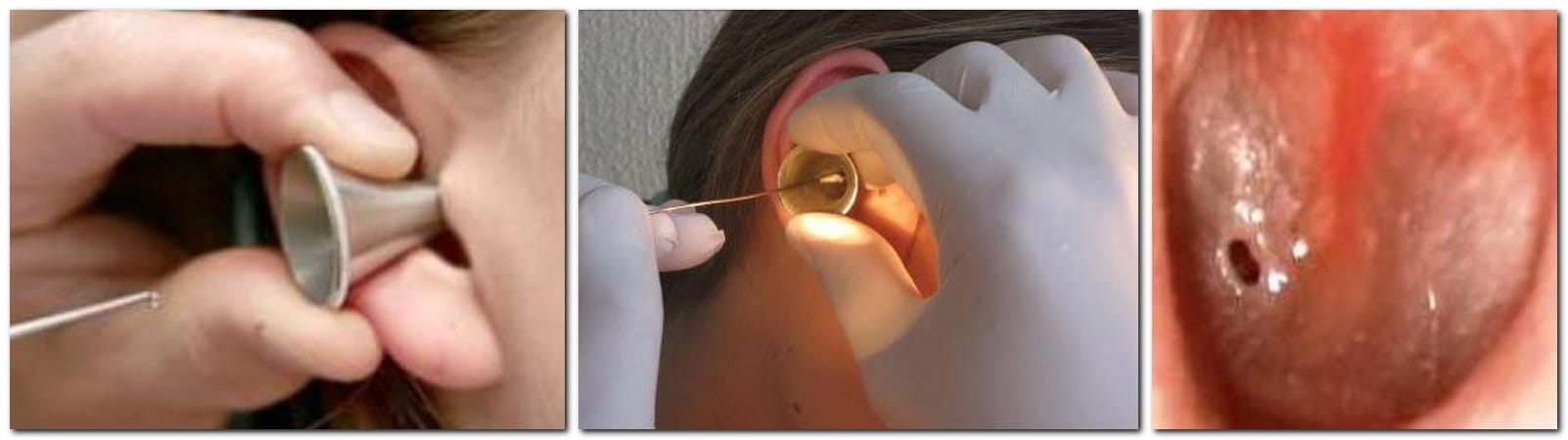 Парацентез перепонки