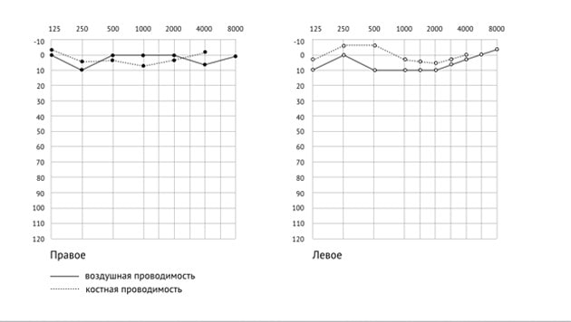 расшифровка аудиограммы